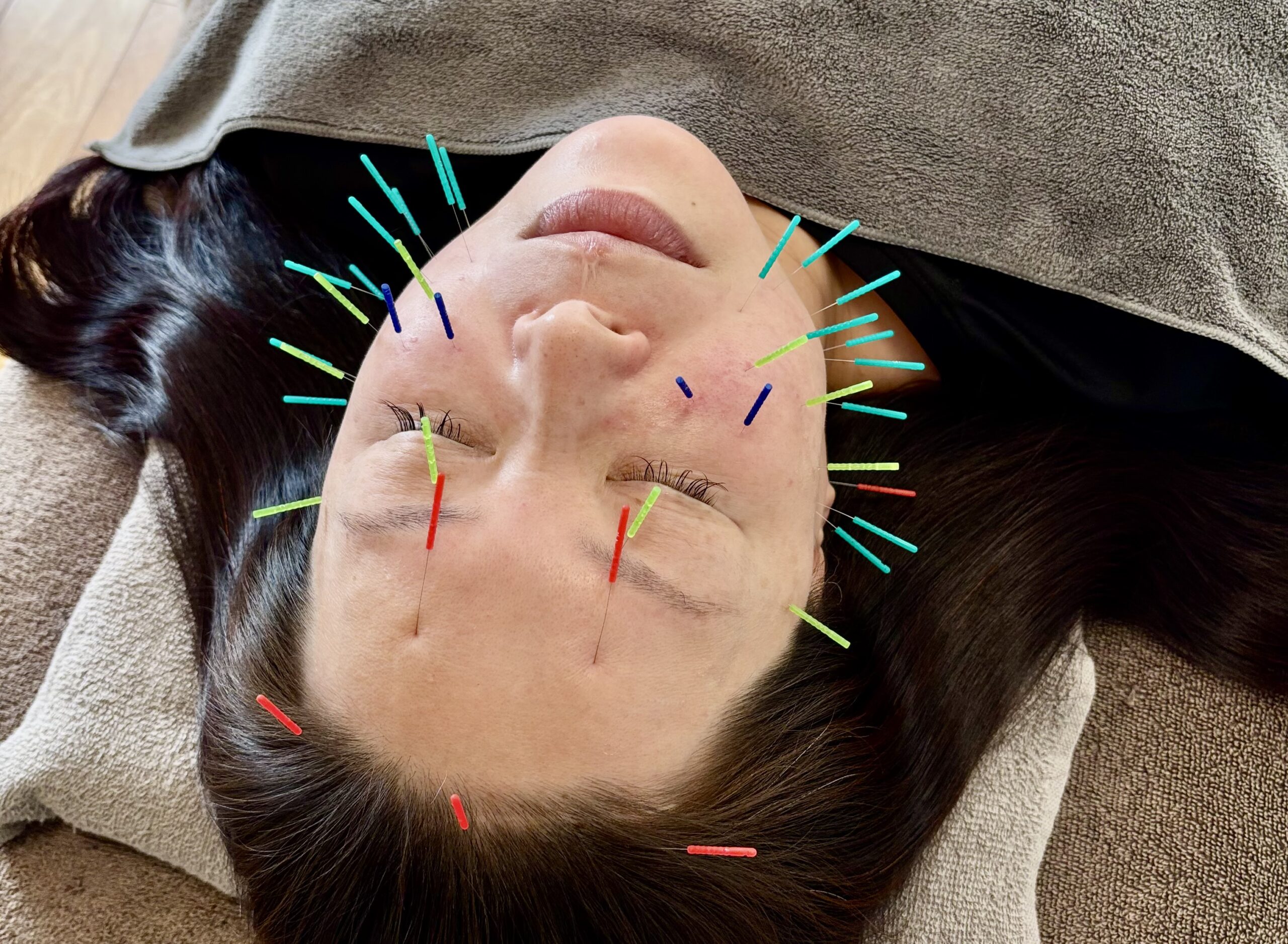 美容鍼で加齢による機能低下をカバー